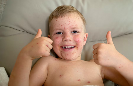 psoriasis on face