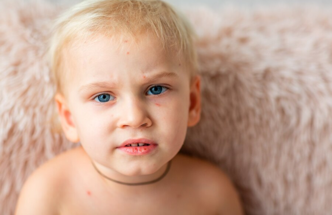 Kids’ Skin Care Routine For Spots: How To Get Rid Of Face Spots?